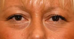 Patient # 14192 Before Photo # 1