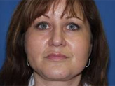 Patient # 38083 After Photo # 2