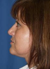 Patient # 38083 After Photo # 4