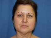 Patient # 38083 Before Photo # 1