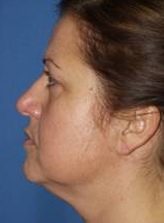 Patient # 38083 Before Photo # 3