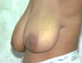 Patient # 78241 Before Photo # 1