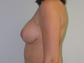 Patient # 69448 After Photo # 4