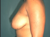 Patient # 34530 After Photo # 8