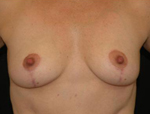 Patient # 80936 After Photo # 2