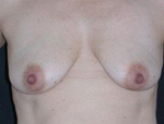 Patient # 80936 Before Photo # 1