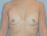 Patient # 44594 Before Photo # 1