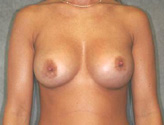 Patient # 28638 After Photo # 2