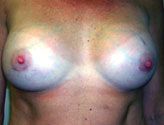 Patient # 34746 After Photo # 2