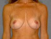 Patient # 14404 After Photo # 2