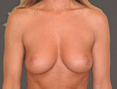 Patient # 63037 Before Photo # 1
