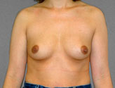 Patient # 50348 Before Photo # 1