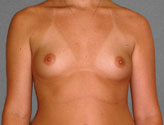 Patient # 33727 Before Photo # 1