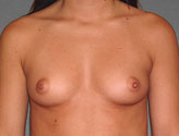 Patient # 23025 Before Photo # 1