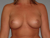 Patient # 20527 After Photo # 2