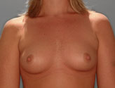 Patient # 20527 Before Photo # 1