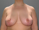 Patient # 13134 After Photo # 2