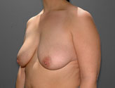 Patient # 13134 Before Photo # 3