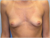 Patient # 41087 Before Photo # 1