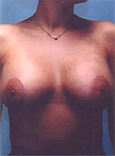 Patient # 47835 After Photo # 2