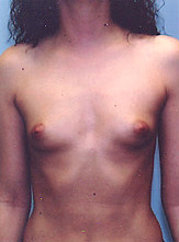 Patient # 67088 Before Photo # 1