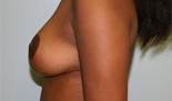 Patient # 85667 After Photo # 4