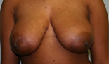 Patient # 85667 Before Photo # 1
