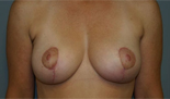 Patient # 26013 After Photo # 2