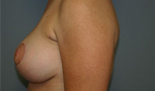 Patient # 26013 After Photo # 4