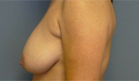 Patient # 26013 Before Photo # 3