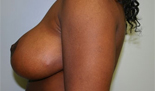 Patient # 13302 After Photo # 4
