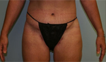Patient # 98369 After Photo # 2