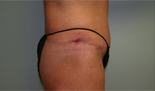 Patient # 98369 After Photo # 4