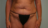 Patient # 98369 Before Photo # 1