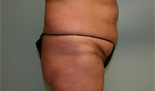 Patient # 98369 Before Photo # 3