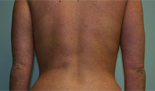 Patient # 63704 After Photo # 4