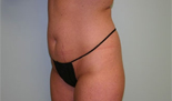 Patient # 63704 Before Photo # 5