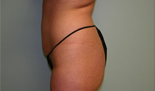 Patient # 63704 Before Photo # 7