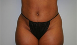 Patient # 12836 Before Photo # 1