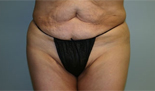 Patient # 51097 After Photo # 2
