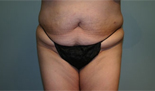 Patient # 51097 Before Photo # 1