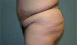 Patient # 51097 Before Photo # 3