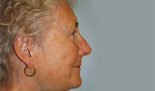 Patient # 43740 After Photo # 4
