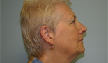 Patient # 43740 Before Photo # 3
