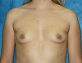 Patient # 35004 Before Photo # 1