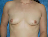 Patient # 81362 Before Photo # 1