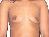 Patient # 12704 Before Photo # 1