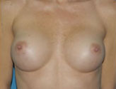 Patient # 23776 After Photo # 2