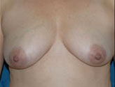 Patient # 29905 Before Photo # 1