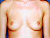 Patient # 15204 Before Photo # 1